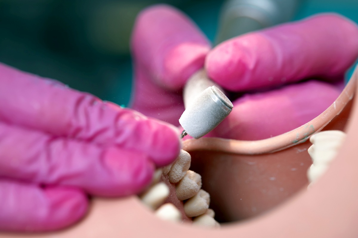 Czy licówki zawsze wymagają szlifowania zębów